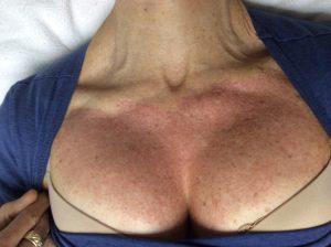 Age spot removal on décolletage