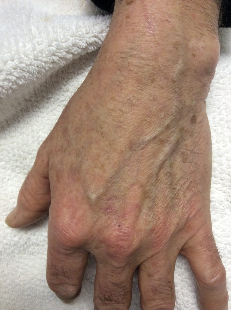 Age spot removal on your hands