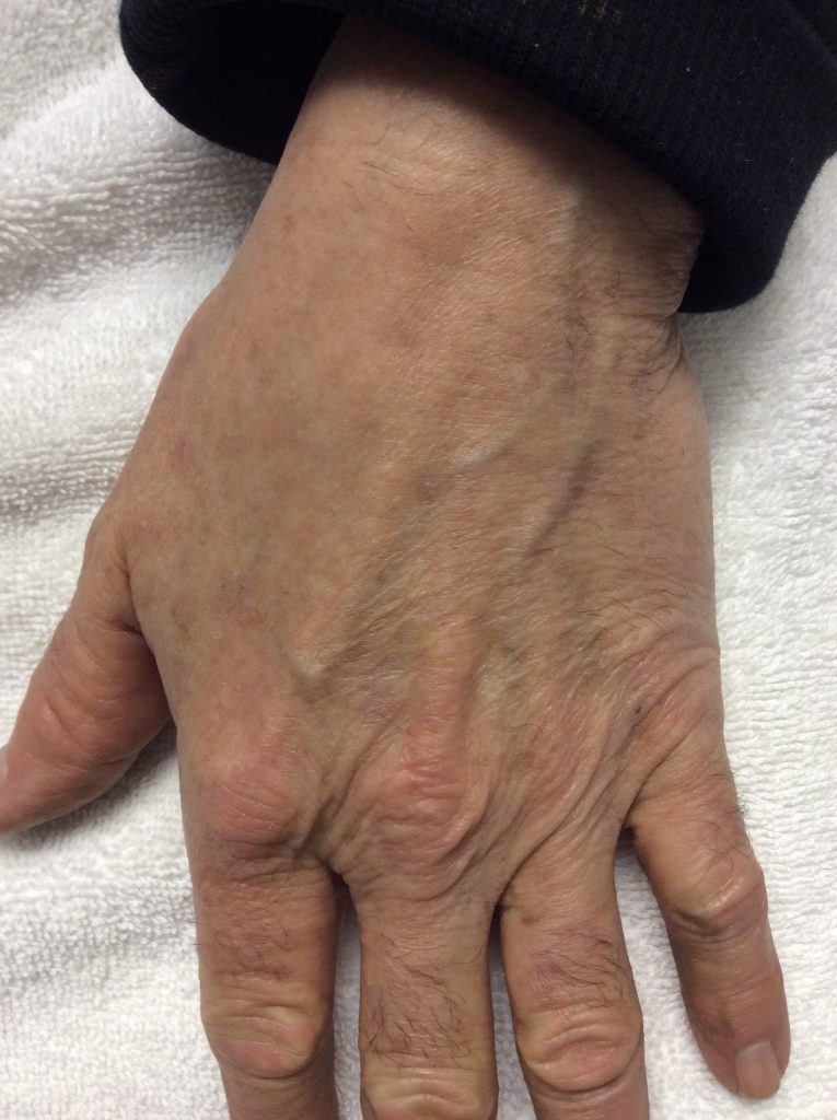 Age spot removal on your hands