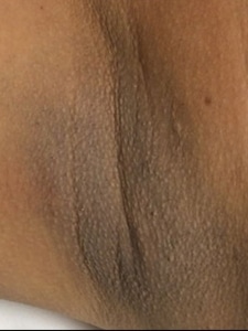 Armpit laser hair removal