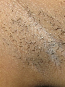 Underarm laser hair removal