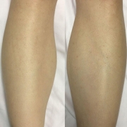 Laser Hair Removal Vs Waxing - After Image
