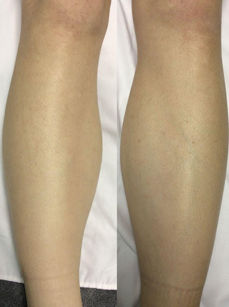 Laser Hair Removal Vs Waxing - After Image