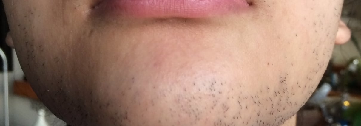 Permanent Laser Hair Removal For Men's Face