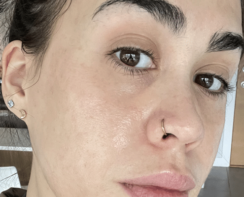 Skin Resurfacing at Urban Body Laser