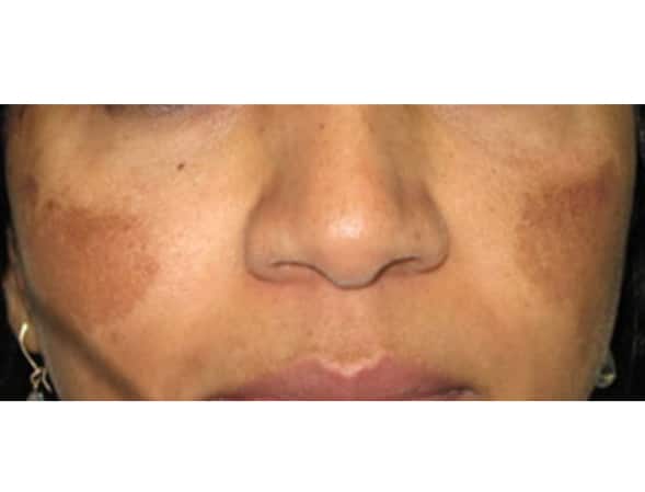 Photorejuvenation for Pigment on Face Before