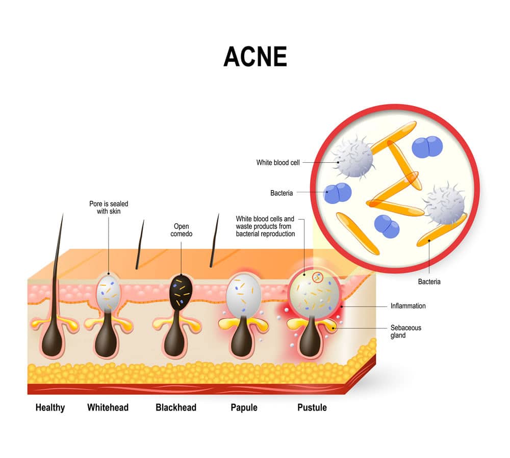 Cutaway of the skin showing what causes butt acne