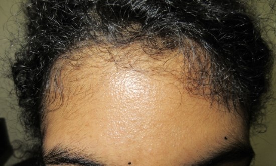Hairline before laser hair removal