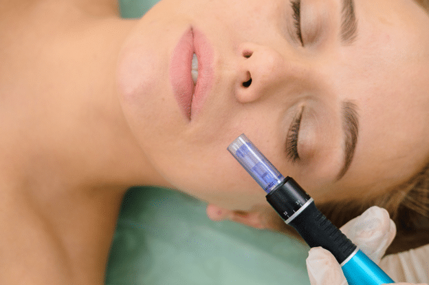 Discover the impact of micro-needling before and after the treatment at Urban Body Laser