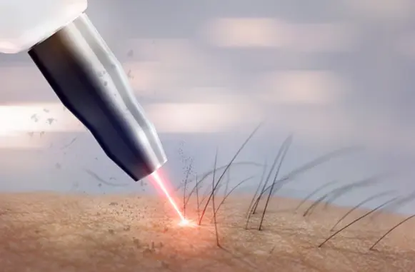 Close-up view of a laser hair removal treatment in action, with a laser beam focusing on dark hair follicles against skin, representing a permanent hair removal method for men's backs.