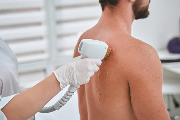 Urban Body Laser technician performing men’s back hair removal with laser treatment in Vancouver.