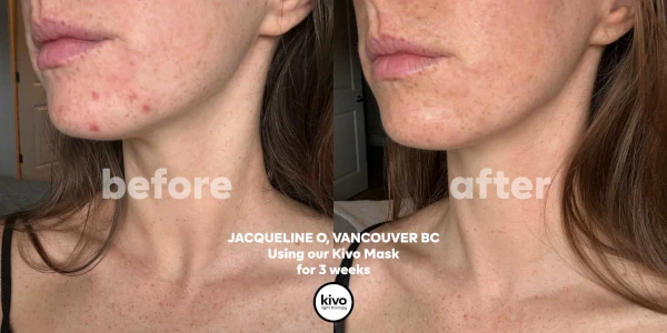 anti-acne-with-red-light-therapy
