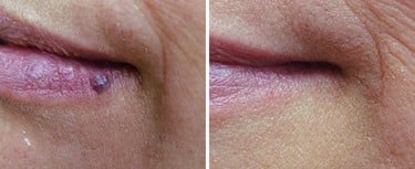 Clinical Results – Hemangioma Treatment 