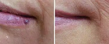 Clinical Results – Hemangioma Treatment 