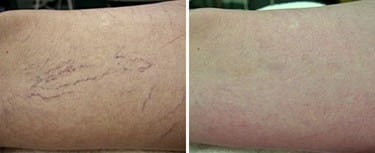 Clinical Results – Spider Vein Removal 