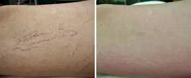 Clinical Results – Spider Vein Removal 