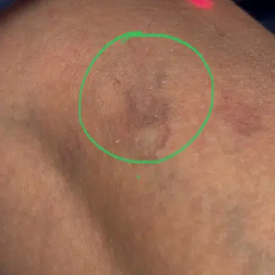 Laser Vein Removal During