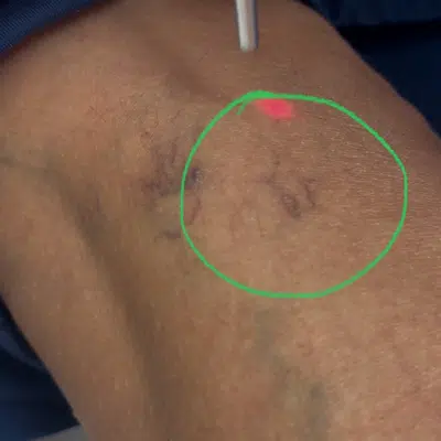 Laser Vein Removal In Progress