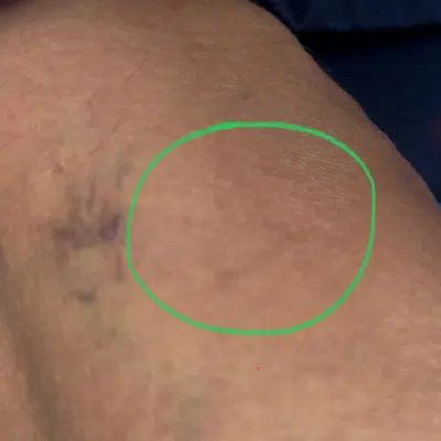 Laser Vein Removal After