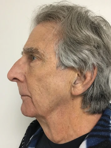 Before and After Photorejuvenation Treatment