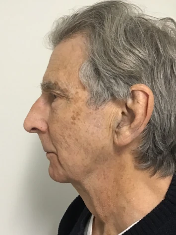 Before and After Photorejuvenation Treatment