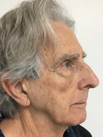 Before and After Photorejuvenation Treatment