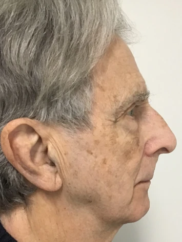 Before and After Photorejuvenation Treatment