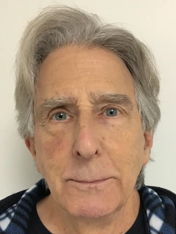 Before and After Photorejuvenation Treatment
