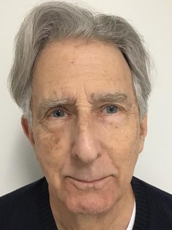 Before and After Photorejuvenation Treatment