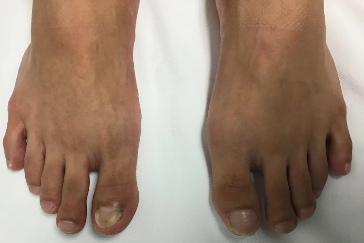 After Toenail Fungus Treatment