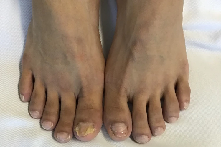 Before Toenail Fungus Treatment