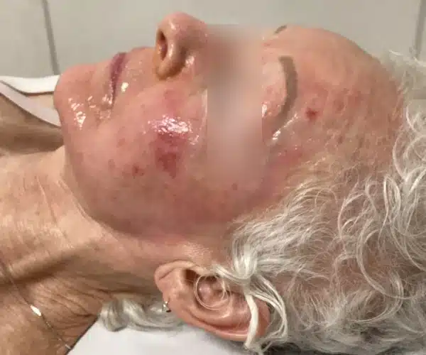 Lipid Mask only 10 minutes later