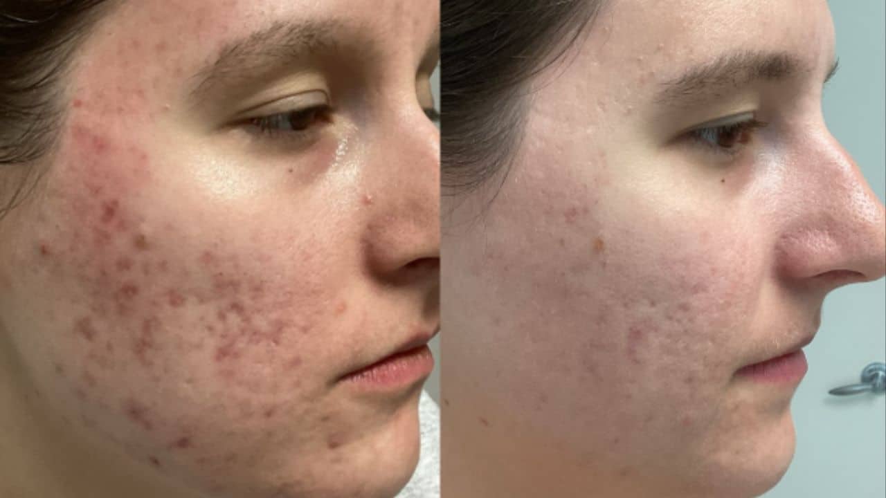 Purasomes exosome treatment at Urban Body Laser designed to repair, calm, and rejuvenate the skin.