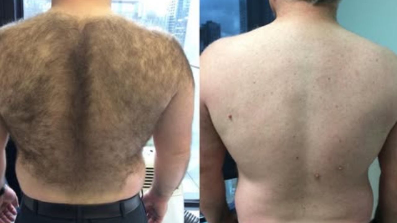 Before and after image showing male back hair removal with visibly smooth skin after laser treatment.