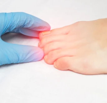 Toenail Fungus Laser Treatment