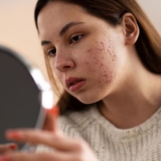 Teen Acne & Acne Scarring Treatments