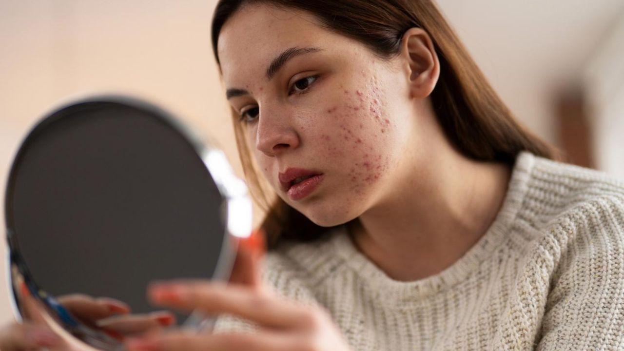 Teen Acne & Acne Scarring Treatments