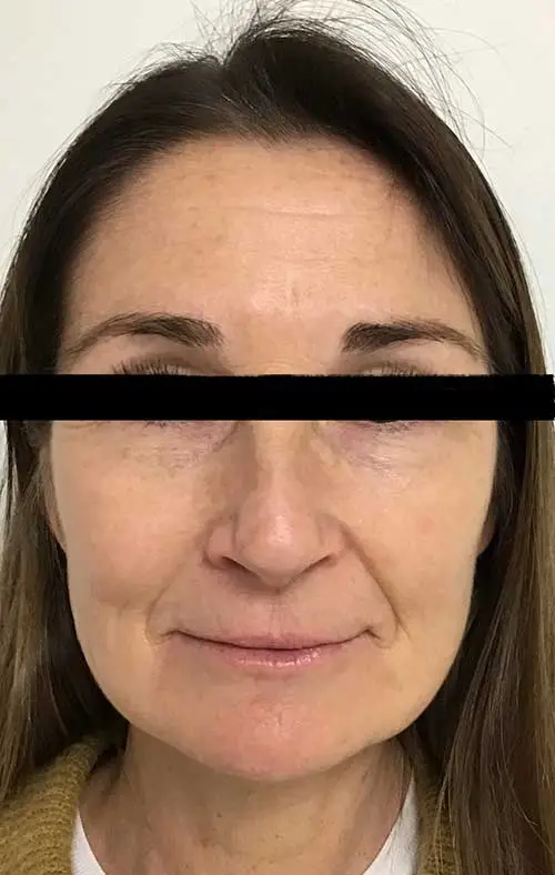 After glow with Microneedling with Exosomes