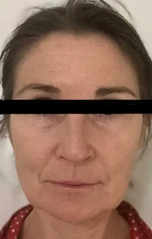 Before the Microneedling Treatments 