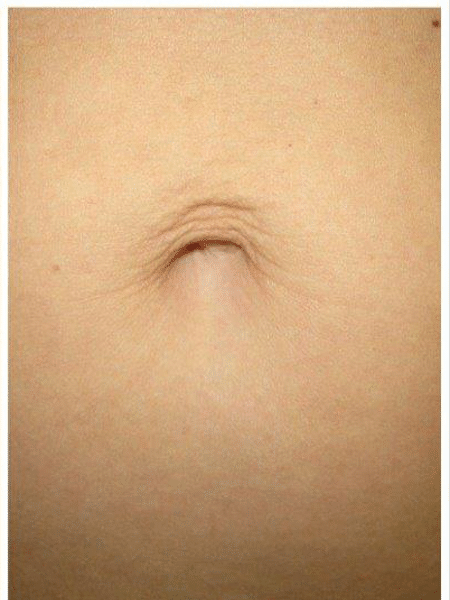 Laser skin tightening after the treatment 