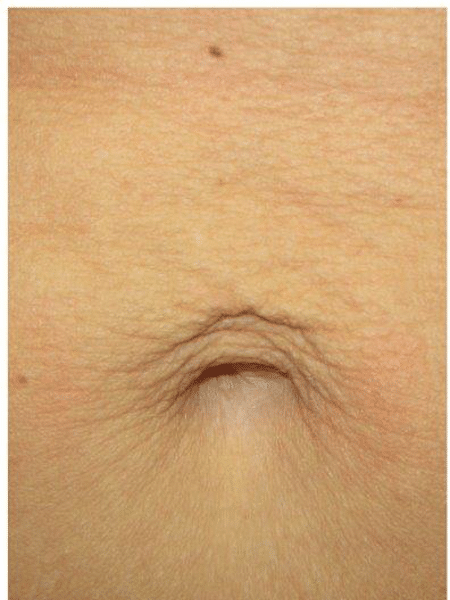  Laser skin tightening before the treatment