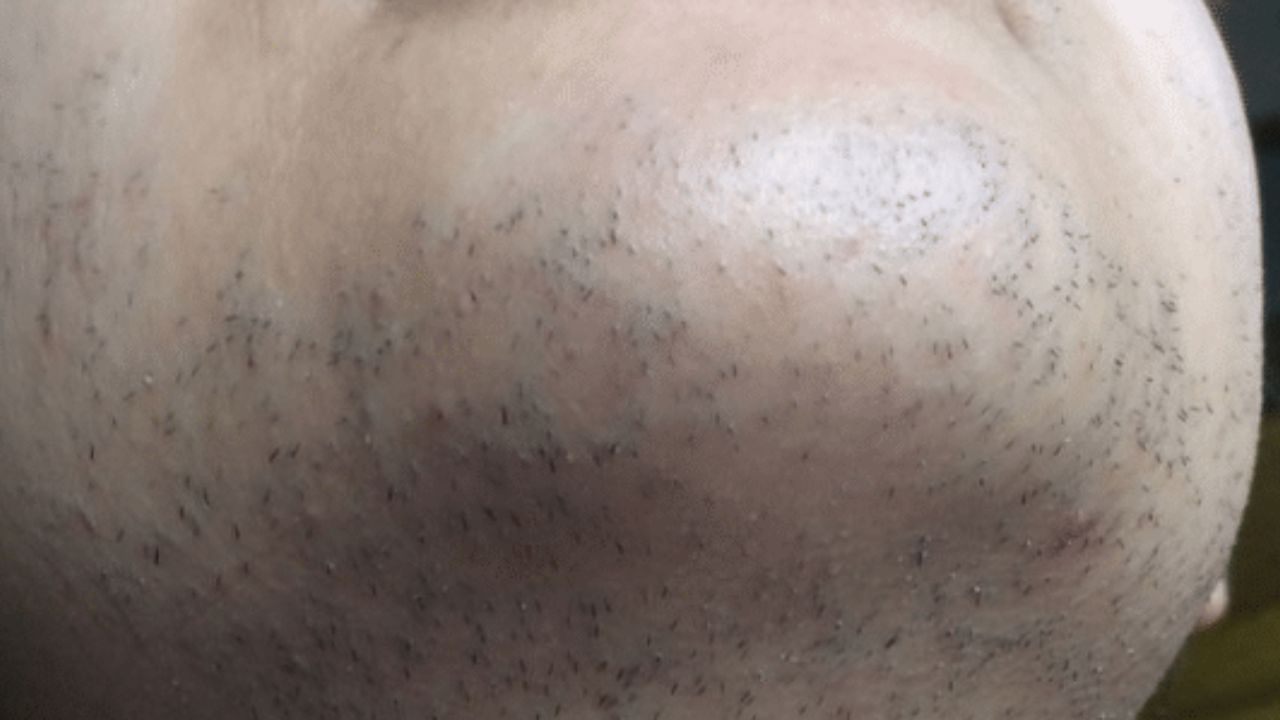  Chin before laser hair removal showing visible hair growth and uneven texture
