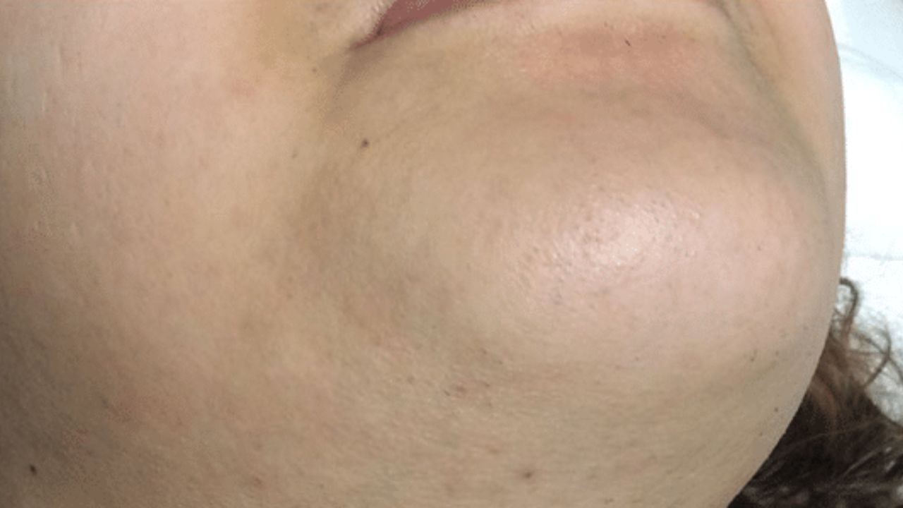 Chin after laser hair removal showing smoother skin and reduced hair growth