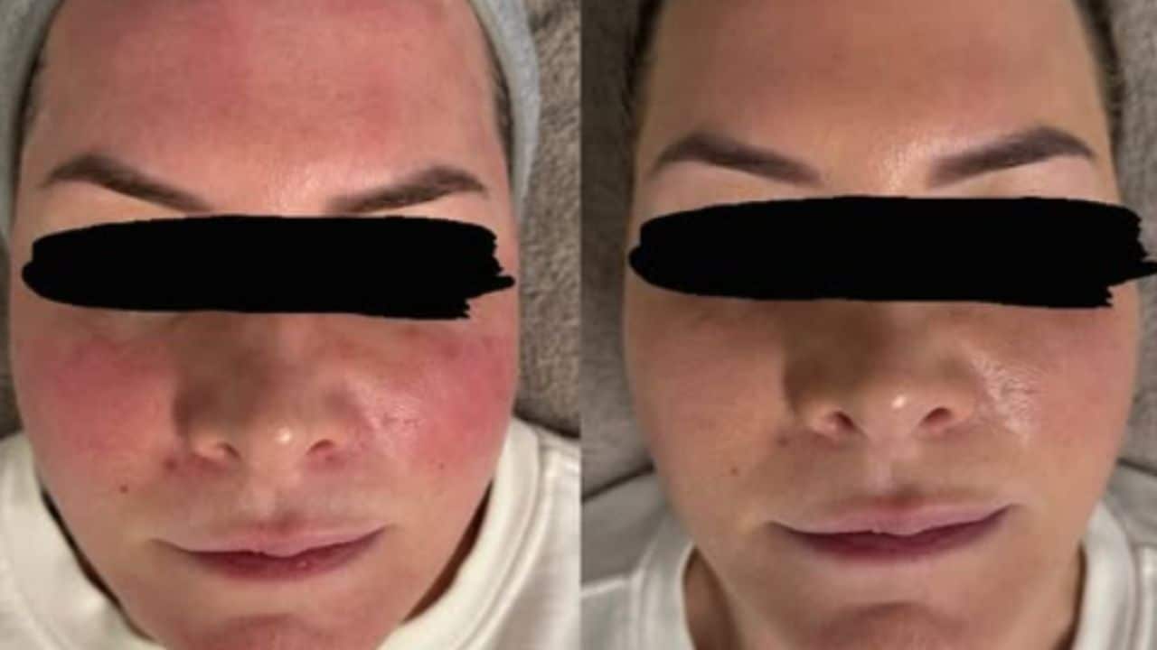 Before and after BBL treatment showing clearer, glowing skin with makeup finish
