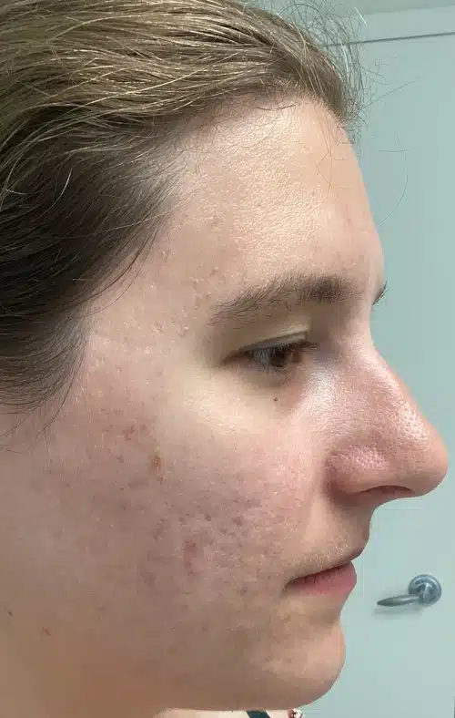 Woman with reduced dark spots and visible skin glow after treatment