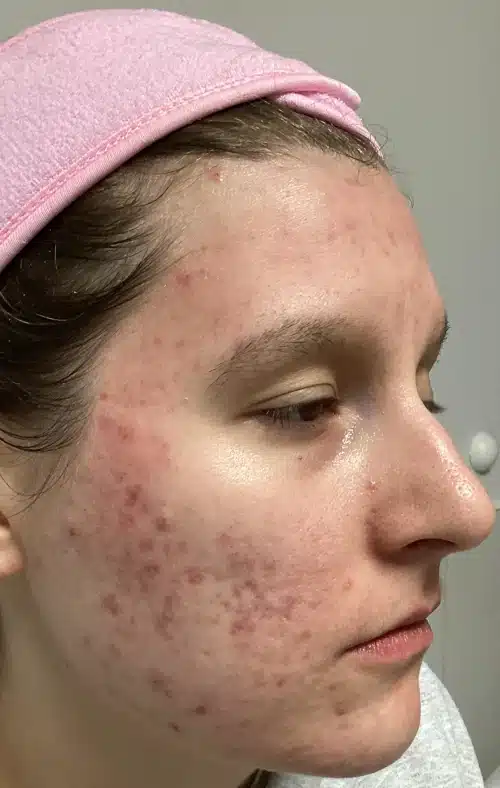 Close-up of facial skin showing dark spots and pigmentation issues