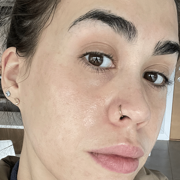 fter photo showing skin improvement after treatment, highlighting smoother, firmer, and glowing skin