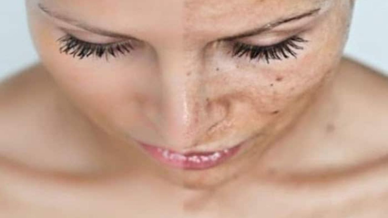 Before and after IPL treatment showing reduced sun spots and clearer, more even skin tone on the face
