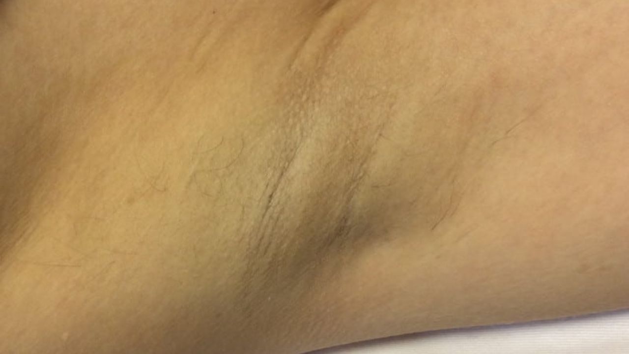 After underarm laser hair removal showing smooth skin, reduced hair growth, minimal stubble, and a more even skin tone.
