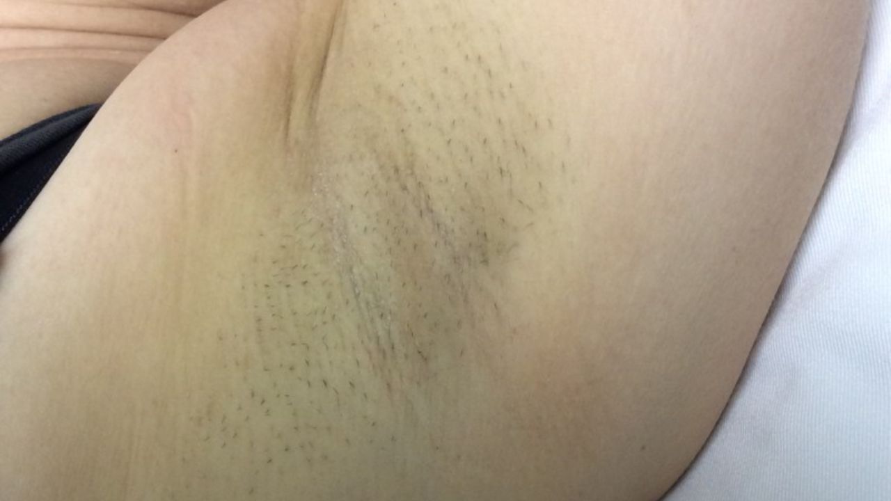 Before underarm laser hair removal showing visible hair growth, dark shadow, and uneven skin tone with stubble.